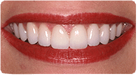 Costa Rica Porcelain Veneers After