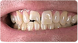 Costa Rica Dental Bonding, before