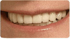 Dental Bridge After