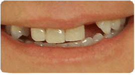 Costa Rica Dental Bridge Before