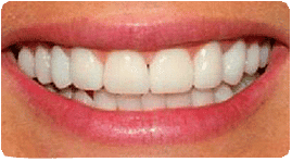 Costa Rica Dental Crown, After