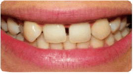 Costa Rica Dental Crown, Before