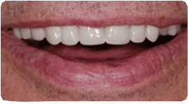Costa Rica Partial Dentures, After