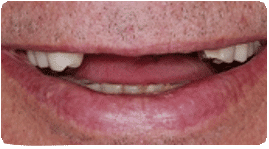 Costa Rica Partial Dentures: Before