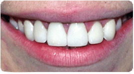 Costa Rica Root Canal, After