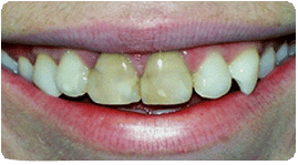 Costa Rica Root Canal, Before