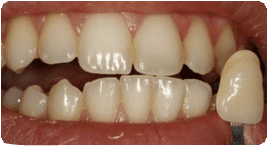 Teeth Whitening Before illustration