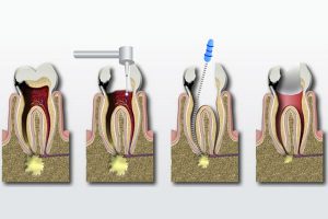 Root Canal Process Costa Rica
