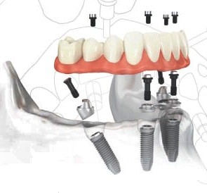 All-on-Four Dental Dental Implants Costa Rica