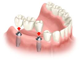 How to select a dental bridge