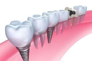 Type of Dental Implants, Costa Rica Implants