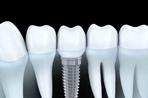 Costa Rica Dental Implants Graphics
