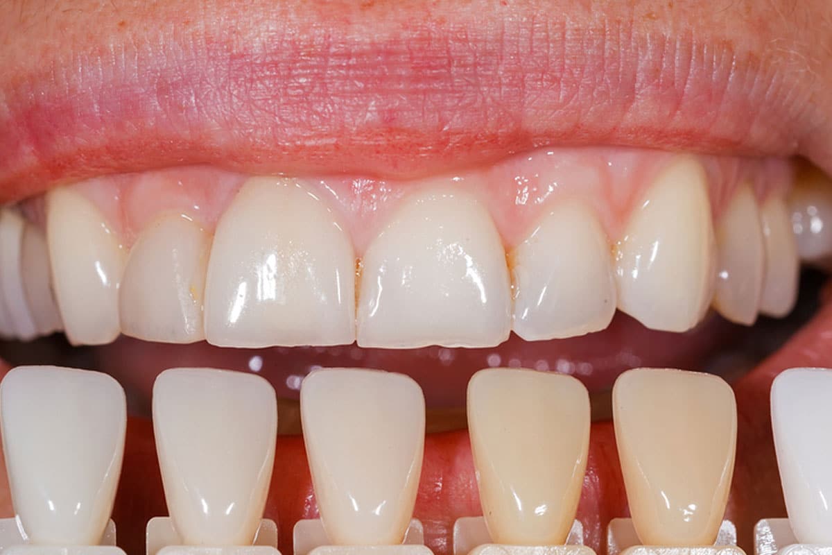 Costa Rica Dental Veneers