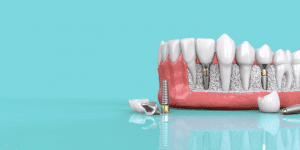5 Steps toward your Dental Implant
