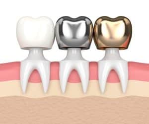 The Core Buildup - Costa Rica Dental