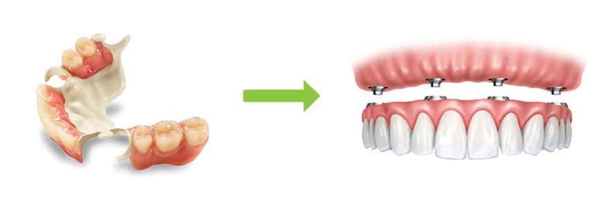 Removable Dentures to All-on-4
