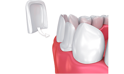 Dental Veneers in Costa Rica - Dental Team