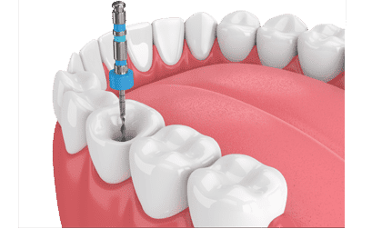 Root canal treatment in Costa Rica - Dental Team