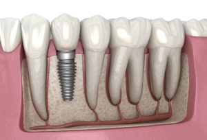 Are dental implants safe - Costa Rica Dental