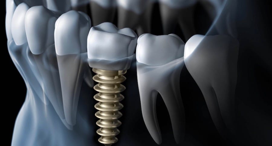 Can dental implants fail? - Costa Rica Dental Team
