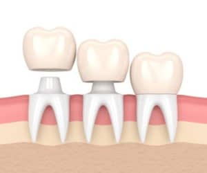 What to expect from dental crowns Costa Rica Dental