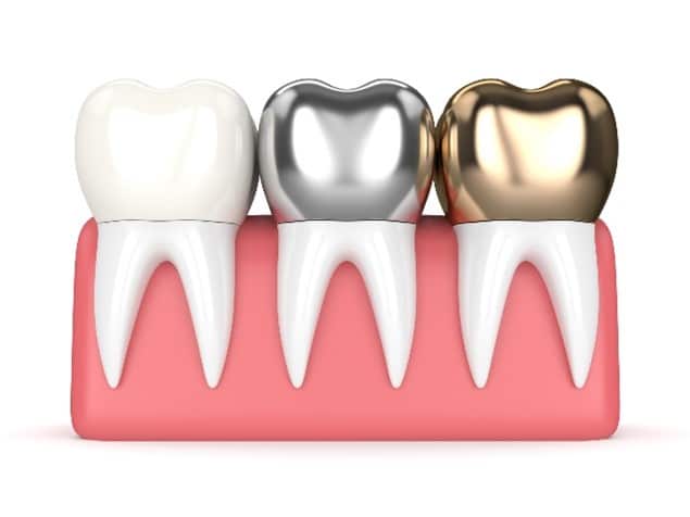 a brief history of the dental crown