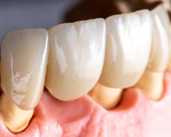 Full Mouth Restoration with Crowns